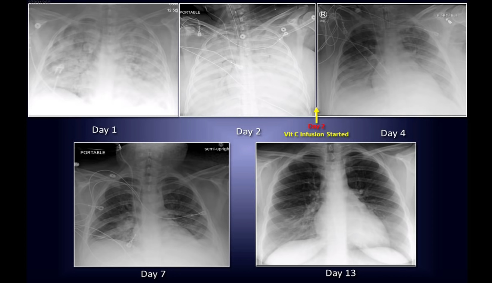 Intravenous Vitamin C: Pathway to a New Therapy to Save Lives ...